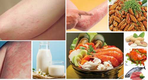 cách trị dị ứng thức ăn